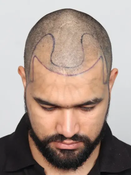 A 10-month natural transformation for a Grade 3 baldness case using 3700 grafts. We recreated the hairline, temples, and frontal zone.