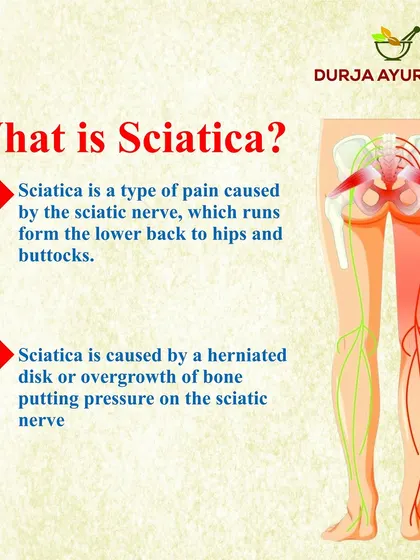 This infographic explains what sciatica is: pain caused by pressure on the sciatic nerve, which runs from the lower back down to the legs. It is often caused by a herniated disk or bone overgrowth.