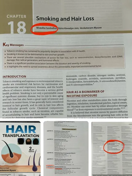A composite image showcasing my authorship in the "Hair Transplantation" textbook, a significant part of my academic work.