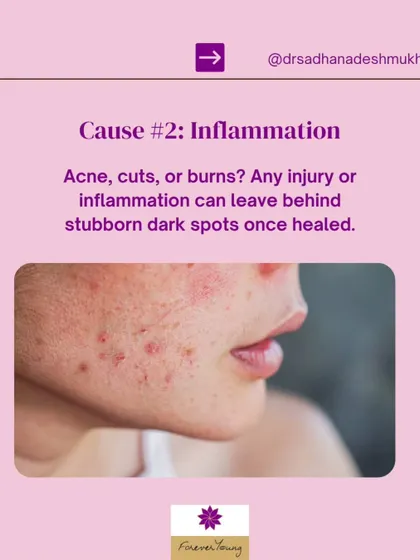 Any inflammation from acne, cuts, or burns can leave behind stubborn dark spots known as post-inflammatory hyperpigmentation. This occurs as part of the skin's healing process. I offer various treatments, including peels and lasers, to effectively fade these marks.