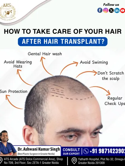 Your journey doesn't end after the procedure. Proper post-transplant hair care is crucial for the best results. I guide all my patients on important steps like gentle washing, sun protection, and avoiding scalp irritation to ensure healthy growth.