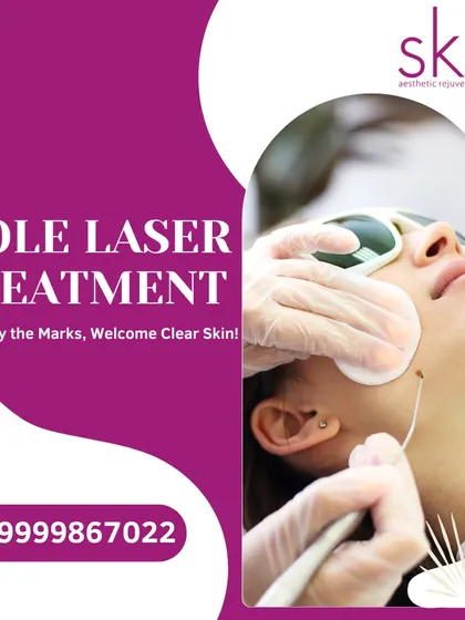 An image promoting my mole laser treatment, promising to fade away marks and welcome clear skin through a safe and effective procedure.