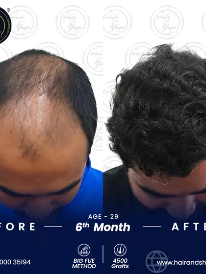 A 6-month result using the BIG FUE method to place 4500 grafts. This technique is perfect for covering large areas of baldness in a single session.