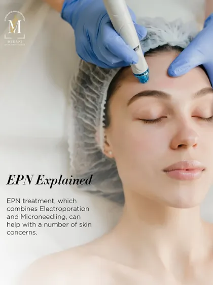 An explanation of EPN treatment, which combines electroporation and microneedling to address a number of skin concerns effectively.