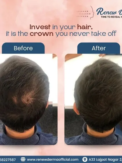 Investing in your hair is investing in the crown you wear every day. This before and after photo shows the incredible difference our combination treatments can make, restoring not just hair, but also confidence.