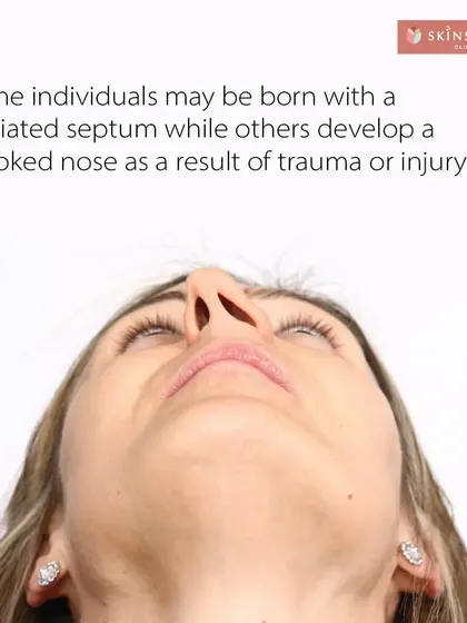 A deviated septum is very common and can result from genetics or injury. Over time, it can worsen breathing difficulties and affect the nose's external appearance, making it a functional reason to consider a septorhinoplasty.