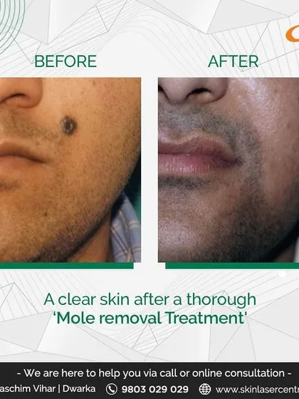 This patient was concerned about a dark mole on his face. The comparison shows the clean removal of the lesion using my mole removal treatment, restoring a more even skin tone and texture without leaving a significant mark.