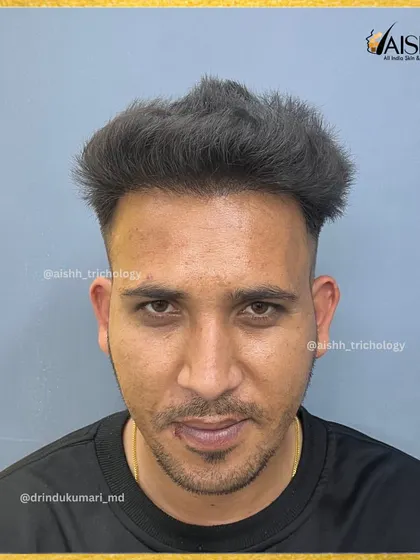 The 'after' result. This frontal view shows a completely restored hairline and impressive density 7 months after the FUE-DHT procedure.