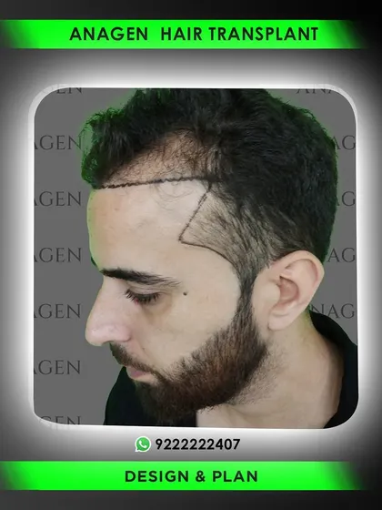 The design and plan are crucial. Here you can see the side profile plan, where we map out the temple points and the flow of the hairline to ensure it looks natural from every angle.