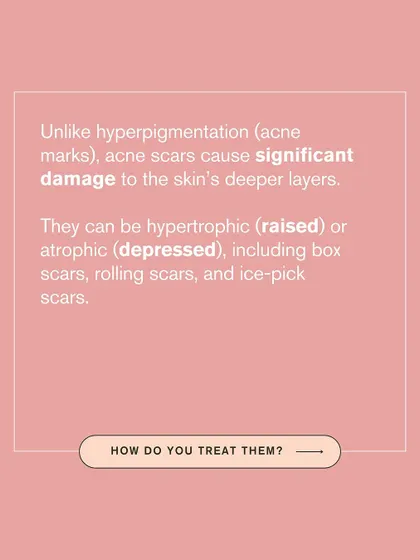 Unlike superficial acne marks, acne scars cause significant damage to the skin's deeper layers. They can be raised (hypertrophic) or depressed (atrophic), requiring specific treatments.