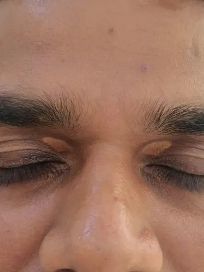 A close-up image of a patient with Xanthelasma on the eyelids. This condition, which I treat with a CO2 laser, involves yellowish deposits of cholesterol under the skin and can be removed easily in a single sitting.
