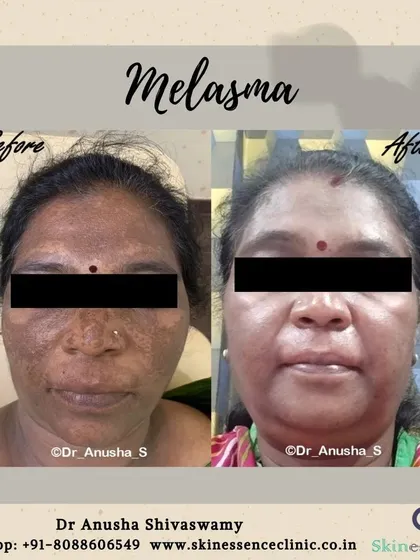 This patient was concerned about Melasma, a type of stubborn facial pigmentation we locally call 'bangu'. After a personalized treatment plan, you can see a dramatic and clear improvement in the pigmentation across her face. This showcases how a targeted approach can effectively manage even the most challenging skin conditions.