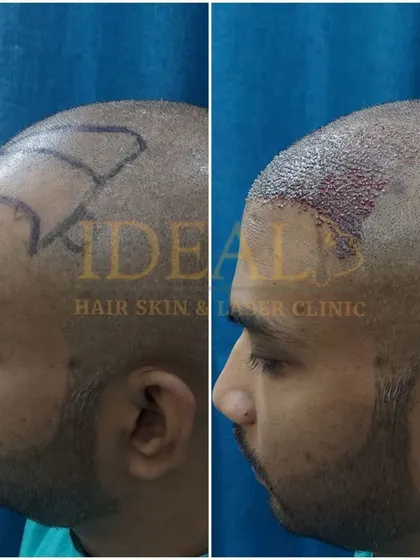 A side-profile comparison of a patient before and after the implantation stage of the FUE transplant, showing the newly created hairline.