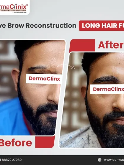 This image shows the precise results of an eyebrow reconstruction using the Long Hair FUE technique. This specialized procedure is ideal for restoring full, natural-looking eyebrows for patients who have experienced hair loss from accidents or other causes.