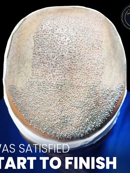 This is where science meets style. A detailed view of newly implanted hair follicles, showcasing the meticulous process of high-density hair restoration.