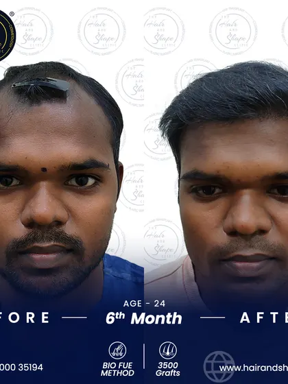 Another great 6-month result from a 3500-graft BIO FUE procedure. The patient's frontal hairline is restored, giving him a more youthful frame.