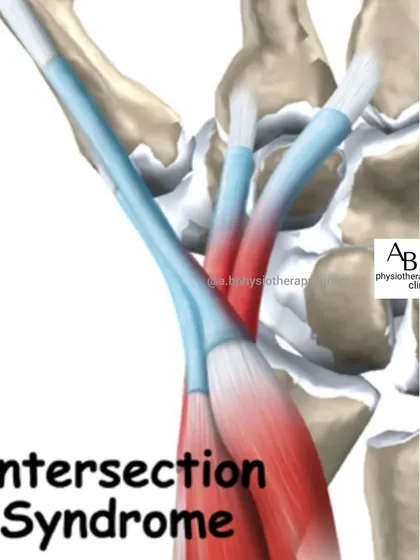 Intersection syndrome is a type of wrist tendonitis common in athletes like rowers and weightlifters due to repetitive movements. This diagram shows where the tendons cross and become inflamed, causing pain and a grinding sensation.