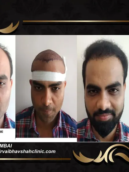 A frontal view of the same patient's journey. Seeing the intermediate step helps set realistic expectations for the recovery and growth timeline.