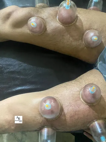 Here you can see static cupping applied to both legs to treat workout-induced stiffness. This symmetrical application ensures balanced recovery, addressing muscle soreness in the quadriceps and surrounding tissues.