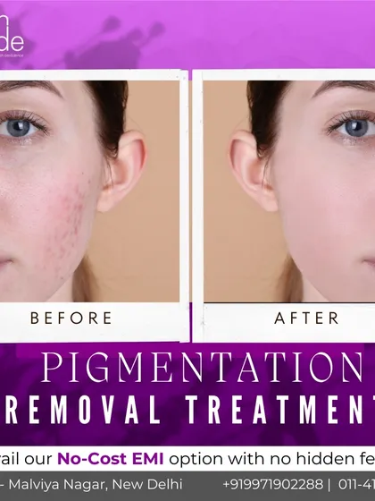 A clear example of how our pigmentation removal treatments work. We target dark spots and uneven tone to reveal a brighter, smoother complexion underneath.