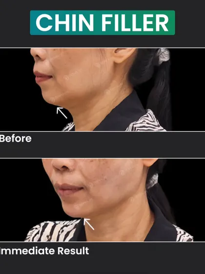 A well-defined chin is key to facial harmony. This before-and-after image shows the immediate result of using a chin filler to improve the patient's side profile and create a more balanced lower face.