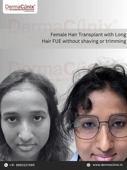 Another example of a female hair transplant using our Long Hair FUE method. This approach avoids the social stigma associated with shaving the head, helping women regain their confidence with ease.