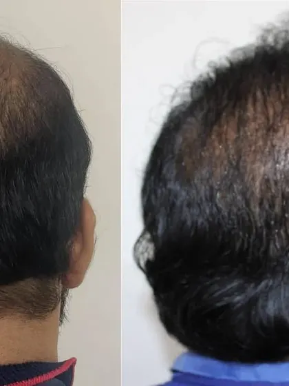 This before-and-after shot from the back highlights the significant improvement in coverage for the crown and upper scalp.