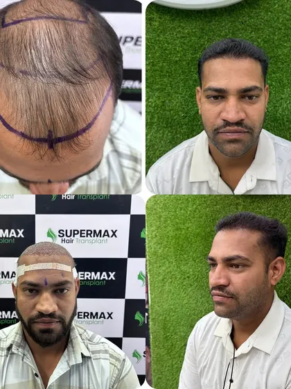 Dekho 7 mahine ka result. This is a complete before and after transformation with 4700 grafts. Notice the natural hairline and the density we achieved. This is the level of quality and artistry I promise every single client.