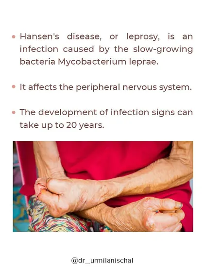 Hansen's disease, or leprosy, is caused by a slow-growing bacterium and primarily affects the peripheral nervous system. The signs of infection can take up to 20 years to develop, which is why awareness of its early symptoms is so important for diagnosis and treatment.