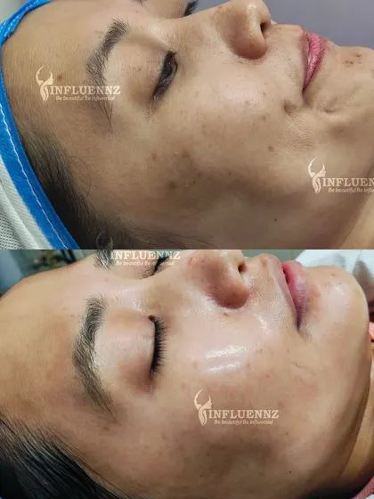 The Radian Blend treatment at work. You can see how the skin's luminosity and texture have improved, giving it a healthy, dewy glow.