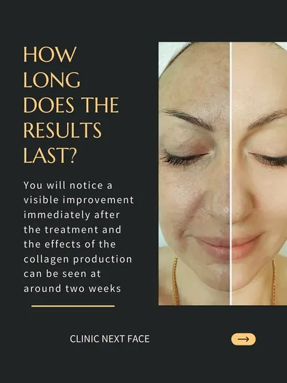 How long do the results of our Organic Lift last? You will see visible improvement immediately, with collagen production effects becoming apparent around two weeks. The full results last for about 6-8 months after a course of three sessions.