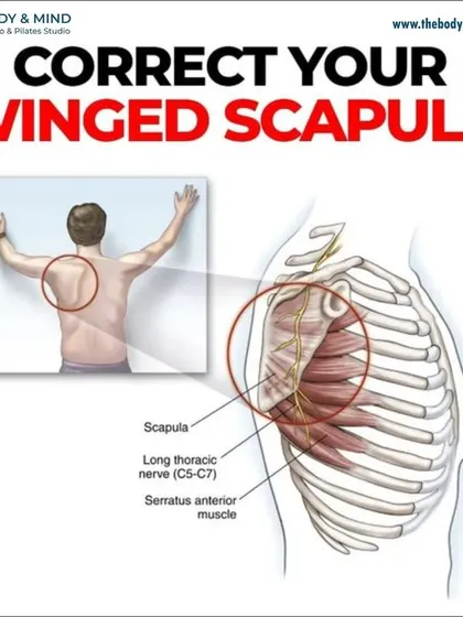 This diagram illustrates a winged scapula, where the shoulder blade protrudes from the back. This is often due to weakness in the serratus anterior muscle, which my targeted PhysioPilates exercises are designed to strengthen and correct.