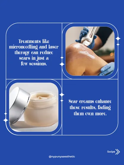 The best approach often combines professional treatments with at-home care. Procedures like microneedling and laser therapy can significantly reduce scars in just a few sessions, while scar creams can enhance and maintain those results.