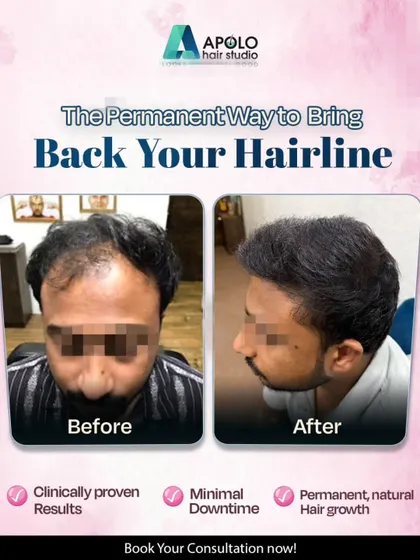 This client came to us looking for a permanent solution to hair loss. We delivered with a clinically proven hair transplant that offers natural, permanent hair growth with minimal downtime.