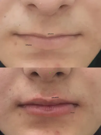 A clear before and after comparison of a lip filler treatment. Notice the improved volume and symmetry, which brings a youthful and refreshed look to the entire lower face.