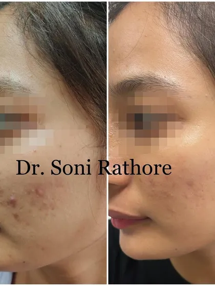 This image, taken two weeks into an acne treatment plan, demonstrates a visible reduction in inflammation. Consistency from the very beginning is what sets the stage for long term clear skin.