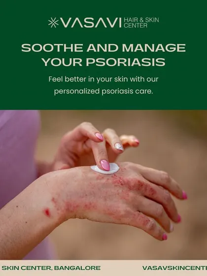 Living with psoriasis can be challenging, but you do not have to manage it alone. I offer personalized psoriasis care, including advanced treatments and expert guidance, to help manage flare-ups and improve your skin's health and comfort.