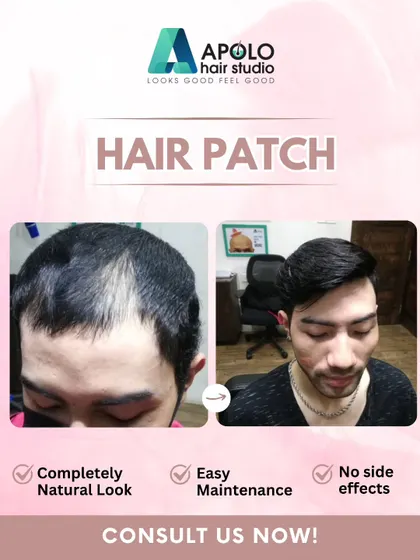 This client's thinning hair was easily resolved with our hair patch solution. The result is a completely natural look that is easy to maintain and has no side effects.
