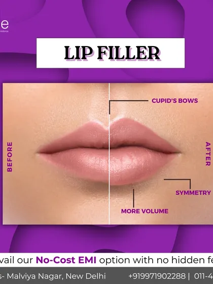 A look at the beautiful, natural-looking results of our lip filler treatment. This before and after comparison highlights how we enhance volume, define the cupid's bow, and create better symmetry for a balanced and confident smile. Our goal is always to enhance your unique features.