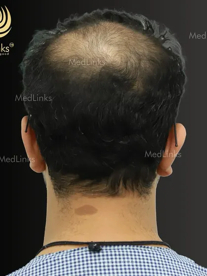 The thinning crown area is clearly visible in this 'before' shot.