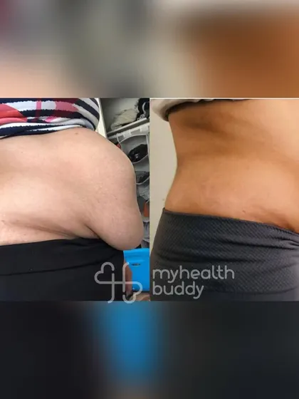 This client not only lost fat but also healed her Diastasis Recti gap in 12 weeks. Her consistency led to feeling more confident and energetic.