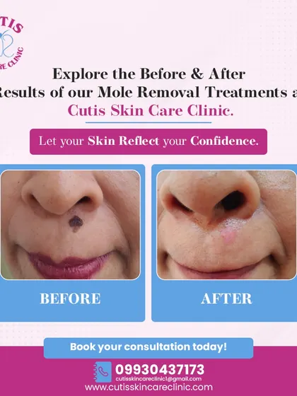 This before and after image shows the result of a dermatologist-supervised mole removal from the face. We used a precise technique to ensure the procedure was quick, safe, and left the skin smooth with minimal scarring, restoring our patient's confidence.