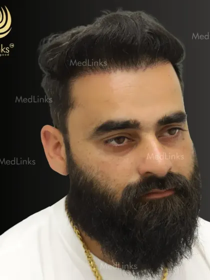 The final result, with a full and natural-looking head of hair. The patient can now style his hair with confidence.