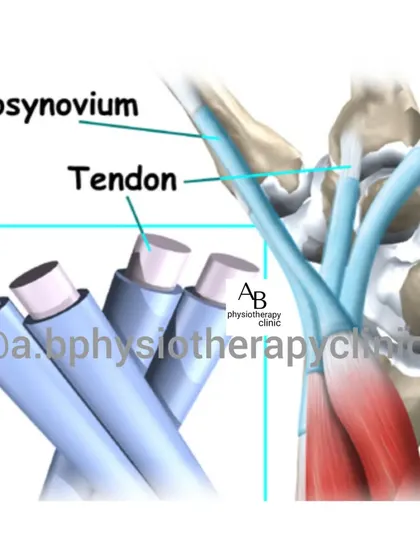 Here you can see the tenosynovium, the sheath that surrounds the tendons. In conditions like Intersection Syndrome, this sheath becomes inflamed, causing pain with movement. Our treatments focus on reducing this inflammation and restoring smooth tendon gliding.