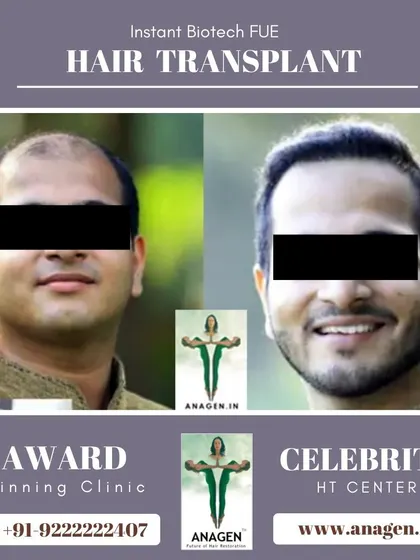 An excellent result from our award winning clinic. This patient's transformation from significant hair loss to a confident smile and full hair is inspiring.