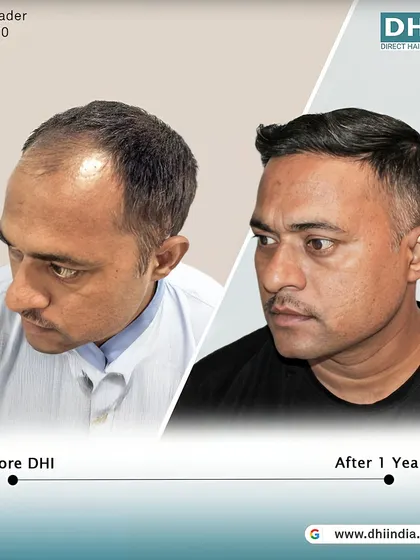 Another side-profile view of the one-year result. This image highlights the expertly crafted hairline that frames his face perfectly, showcasing the artistic skill of our DHI surgeons.