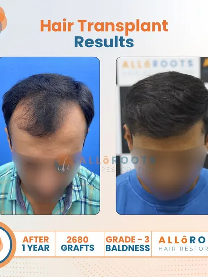 A one-year result for a Grade 3 baldness case using 2680 grafts. These images show the transformation from multiple angles, highlighting the restored density and the clean, natural hairline I designed.