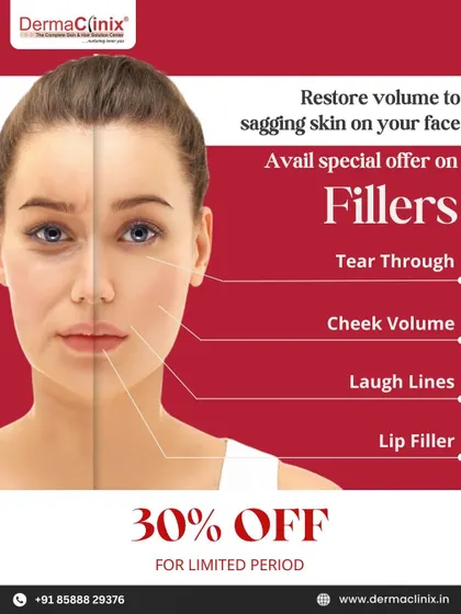 Avail our special offer of 30% off on dermal fillers. This is a great opportunity to restore volume, smooth lines, and enhance your facial contours.