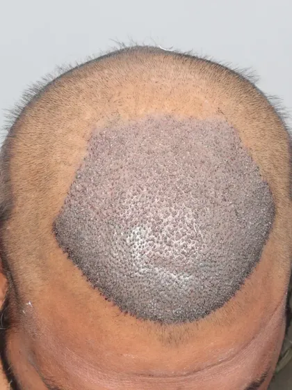 A Grade 4A hair loss case restored with 3500 grafts. These images show the precision of our graft placement.