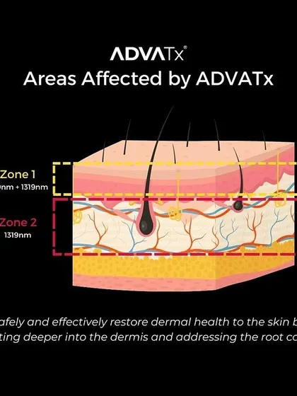 This diagram explains how ADVATx works. By combining two wavelengths, it safely and effectively treats both superficial issues in Zone 1 and deeper concerns in Zone 2 of the dermis.